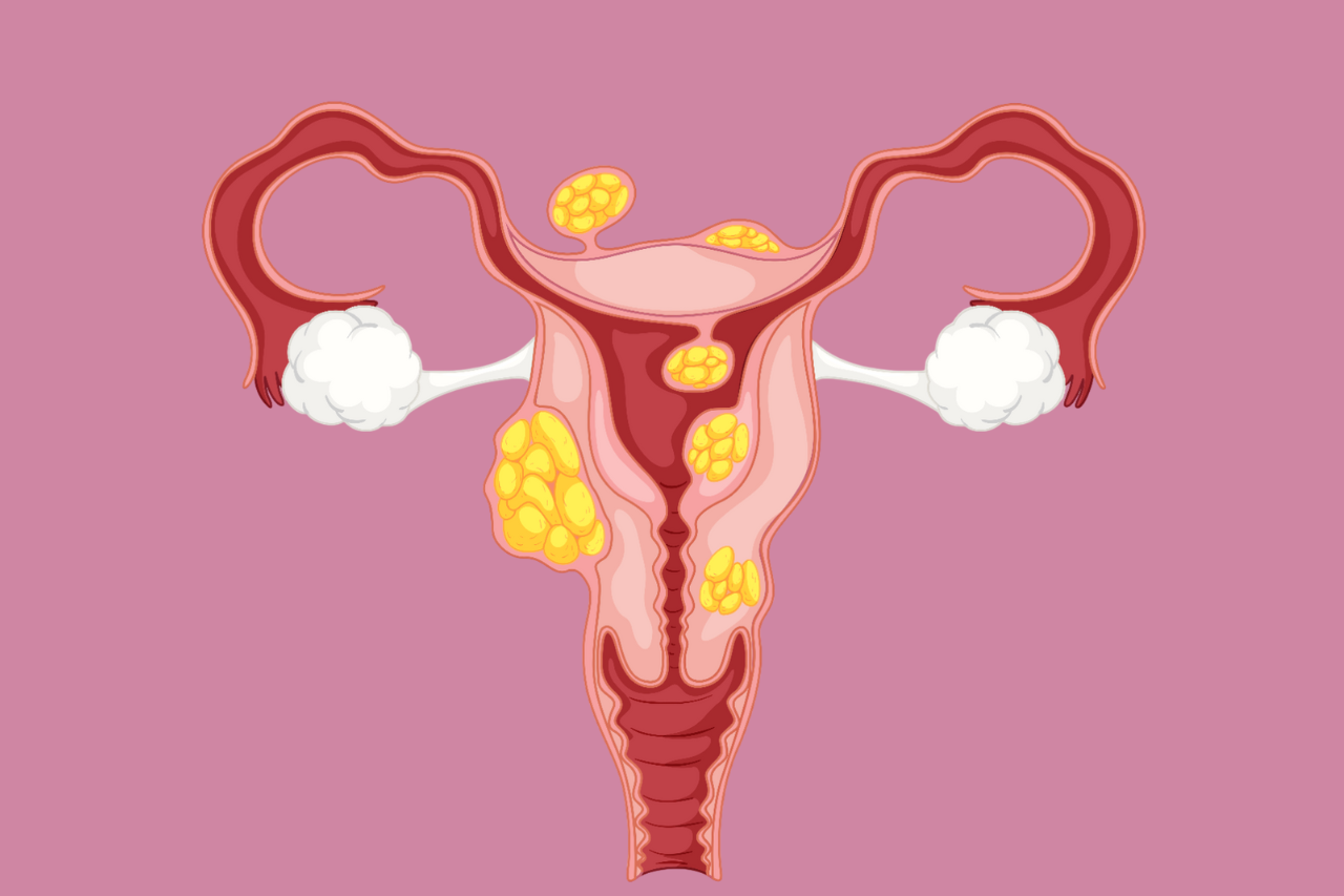 PCOS or Endometriosis